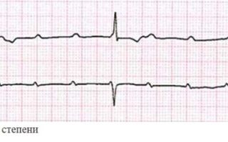 Блокады сердца на экг: что это такое, внутрижелудочная блокада