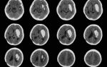 Биопсия головного мозга: показания к операции, методика выполнения