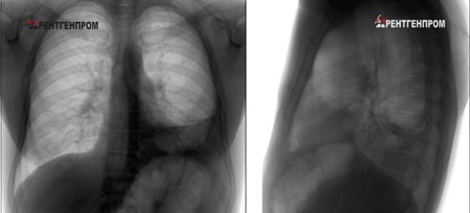 Затемнение в легких на флюорографии: что это значит, причины появления пятен
