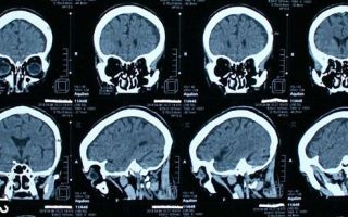 Особенности проведения кт головного мозга