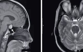 Мрт гипофиза с контрастом: что это, как делают томографию с контрастированием