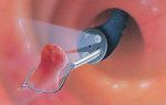 Гистероскопия и удаление полипа цервикального канала, отзывы об эндометрии