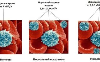 Норма лейкоцитов в крови у мужчин: расшифровка показателей wbc, причины изменения уровня