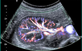 Уздг сосудов почек, дуплексное сканирование (доплерография) почечных артерий