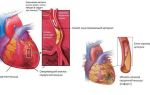 Экг при инфаркте миокарда: признаки патологии на кардиограмме, изменения показателей, фото