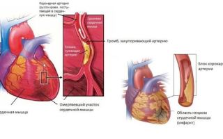 Экг при инфаркте миокарда: признаки патологии на кардиограмме, изменения показателей, фото