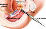 Биопсия предстательной железы: как делают, подготовка, последствия и отзывы