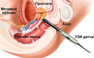 Биопсия предстательной железы: как делают, подготовка, последствия и отзывы