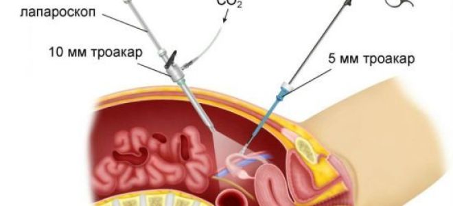 После лапароскопии болит живот: причины, лечение болей