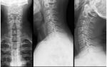 Рентген шейного отдела позвоночника, что показывает рентгенография шеи