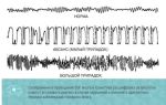 Расшифровка ээг у детей: норма и нарушения работы головного мозга