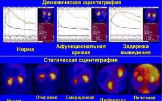 Сцинтиграфия почек (динамическая, статическая, радиоизотопная): показания, подготовка