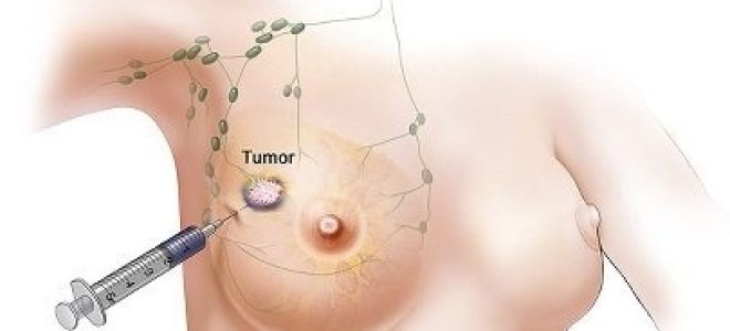 Биопсия молочной железы: что это такое, пункционная и трепан, отзывы