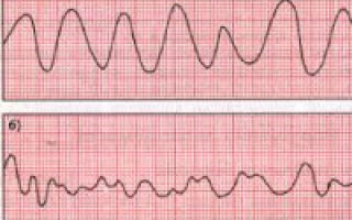 Трепетание предсердий на экг, причины фибрилляции желудочков сердца