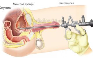 Биопсия мочевого пузыря, как ее берут у мужчин и женщин