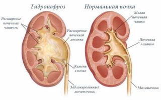 Антеградная пиелография: рентген почек с контрастом (контрастным веществом), подготовка