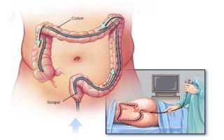 Показания к колоноскопии кишечника, показания к проведению