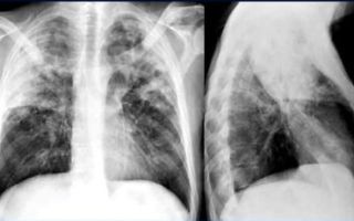 Пневмония на рентгене: особенности проведения рентгенографии, фото