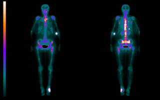 Сцинтиграфия костей скелета: что это такое, подготовка к обследованию
