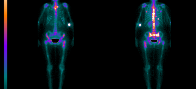 Сцинтиграфия костей скелета: что это такое, подготовка к обследованию
