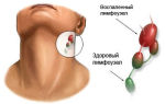 Узи лимфатических узлов: что показывает, подготовка к ультразвуковому исследованию лимфоузлов