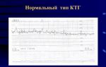 Расшифровка ктг на 34 неделе, возможные отклонения от нормы