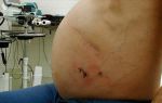 Лапароскопия брюшной полости (диагностическая): показания, подготовка