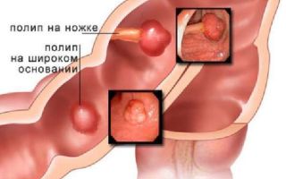 Что лучше ирригоскопия или колоноскопия кишечника: отличия, преимущества