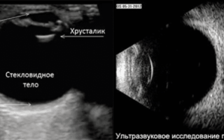 Узи глаза, как делается обследование глазного яблока