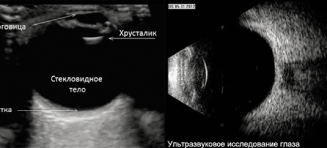 Узи глаза, как делается обследование глазного яблока