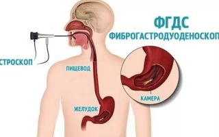 Биопсия желудка с помощью эндоскопии (фгс): что это такое, подготовка