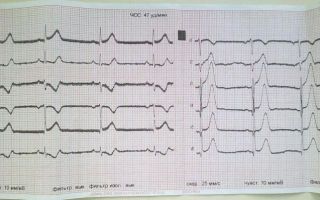 Расшифровка экг у взрослых: норма кардиограммы сердца, таблица показателей, фото