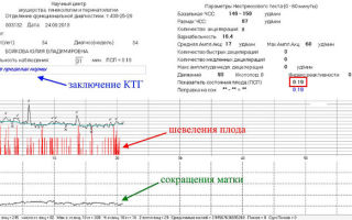 Как выглядят схватки на ктг: способы их определить, показывает ли их диагностика
