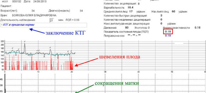 Как выглядят схватки на ктг: способы их определить, показывает ли их диагностика