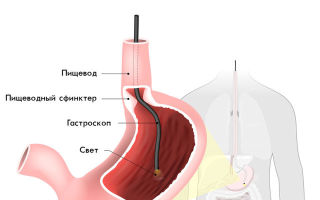 Подготовка к процедуре гастроскопии: как подготовиться, что нельзя делать