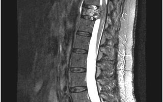 Мрт грудного отдела позвоночника: что показывает, показания, подготовка