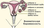 На каком сроке можно определить внематочную беременность на узи, как выглядит