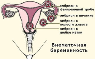 На каком сроке можно определить внематочную беременность на узи, как выглядит