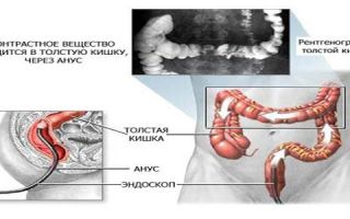 Ирригоскопия кишечника: что это такое, отзывы, как проводится, противопоказания