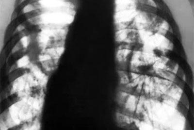 Деформация и усиление легочного рисунка на рентгене (флюорографии): что это