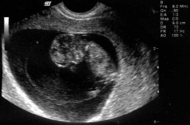 УЗИ на 10 неделе беременности: размер плода, фото, особенности