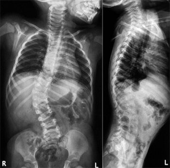 Рентген пояснично-крестцового отдела позвоночника, что показывает рентгенография