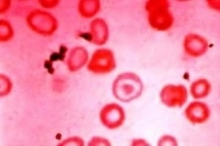 Гипохромия в общем анализе крови у взрослого или ребенка: причины, расшифровка показателей