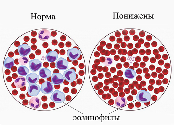 Эозинофилы в анализе крови: норма содержания, что это такое, причины почему понижены