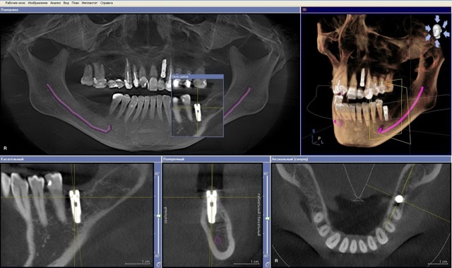 Компьютерная томография зубов (дентальная): показания, подготовка