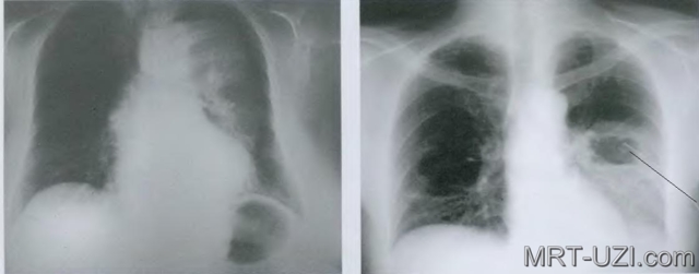 Пневмония на рентгене: особенности проведения рентгенографии, фото