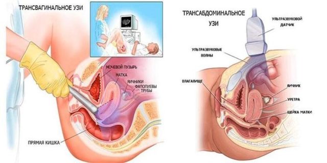 Беременность после гистероскопии: когда и через сколько можно беременеть + отзывы
