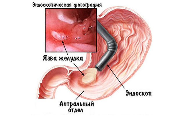 Детская гастроскопия желудка эндоскопом у ребенка, противопоказания у детей