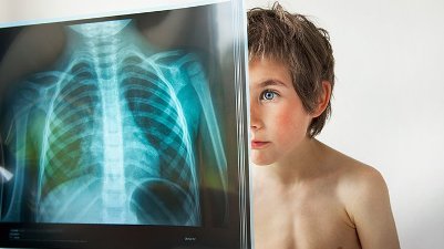 Рентген легких ребенку: показания к детской цифровой рентгенографии, подготовка