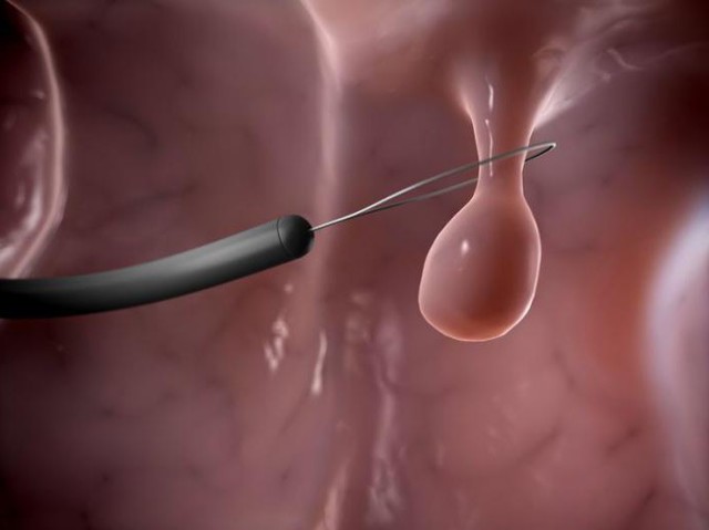 Гистероскопия и удаление полипа цервикального канала, отзывы об эндометрии